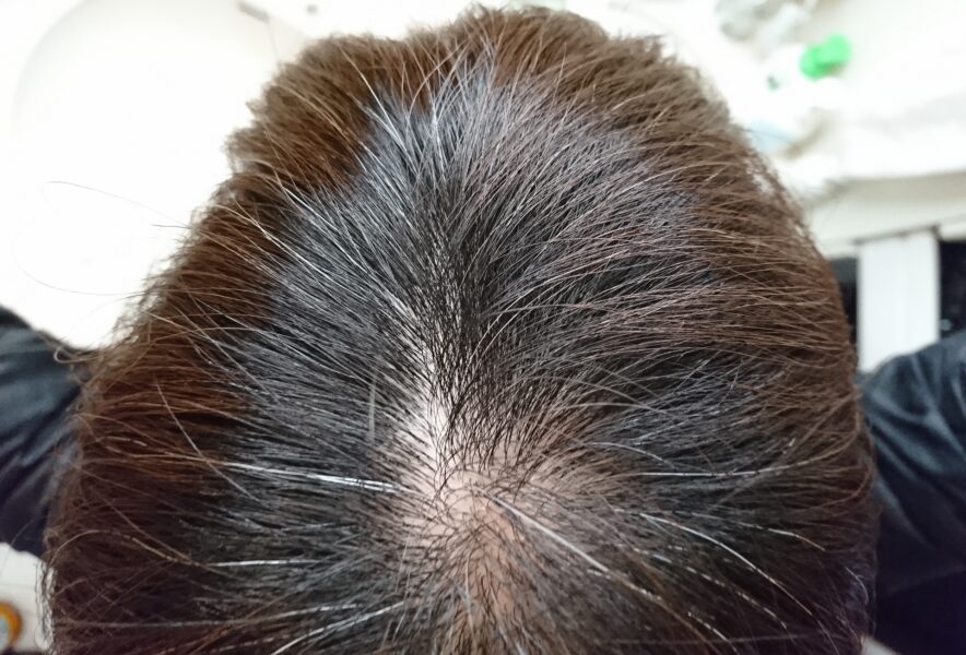 抜け毛が増える季節はある？抜け毛の対策や最新の治療方法まで解説
