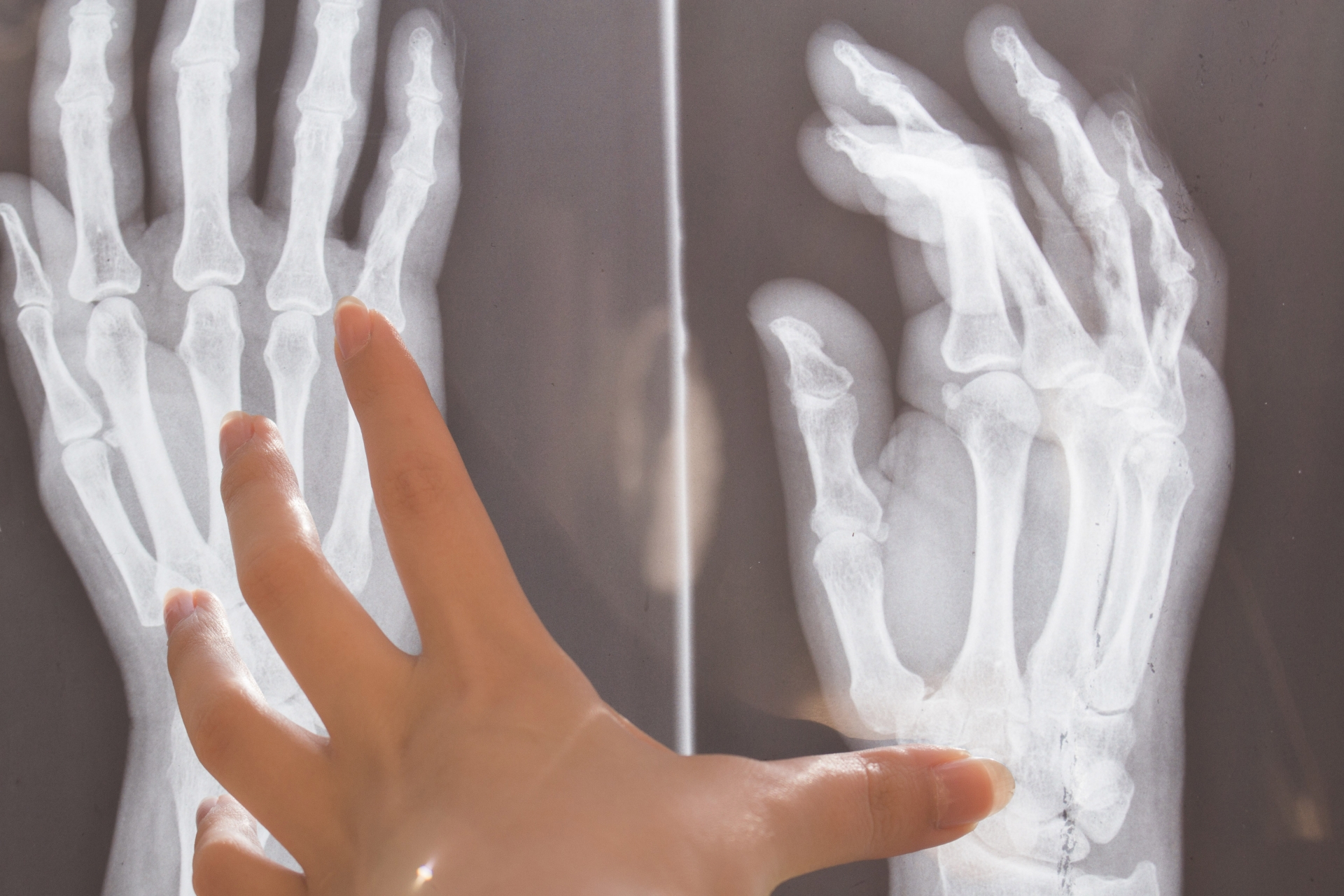 指の変形性関節症の治療法